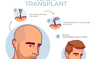 What is Hair Transplants?