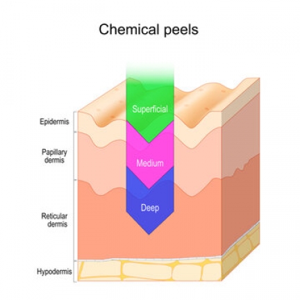 What is Chemical Peel?