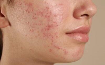 How Does ACNE Affect Social Life?