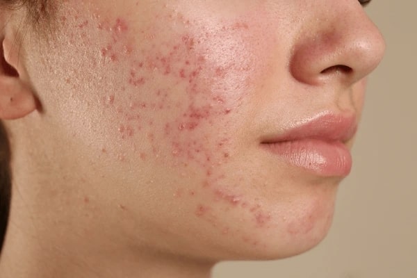 How Does ACNE Affect Social Life?