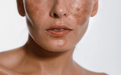 Impact of Hormones on Skin Pigmentation