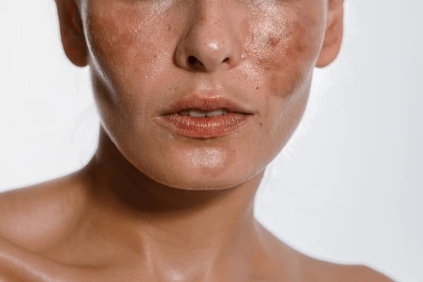 Impact of Hormones on Skin Pigmentation