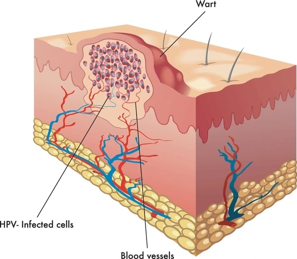 Wart-HPV Infected cells