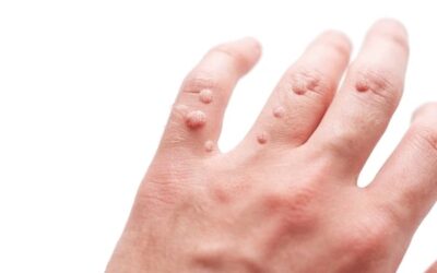 What Are Warts?
