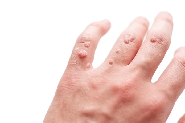 Warts on Hand