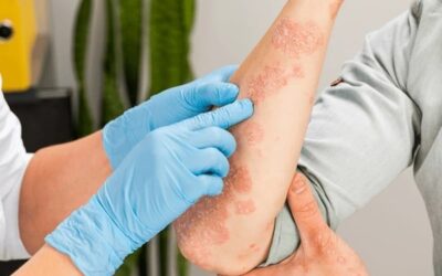 What is Psoriasis: Symptoms, Causes and Treatment