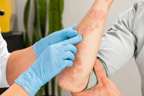 What is Psoriasis