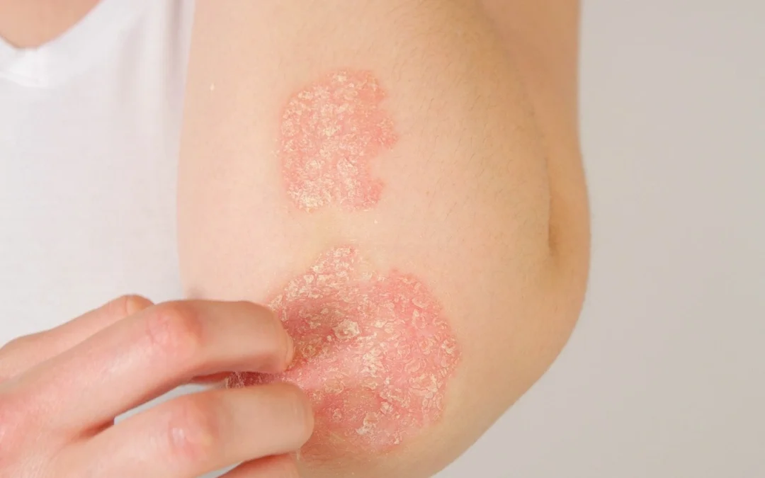 What is Eczema (Atopic Dermatitis)?