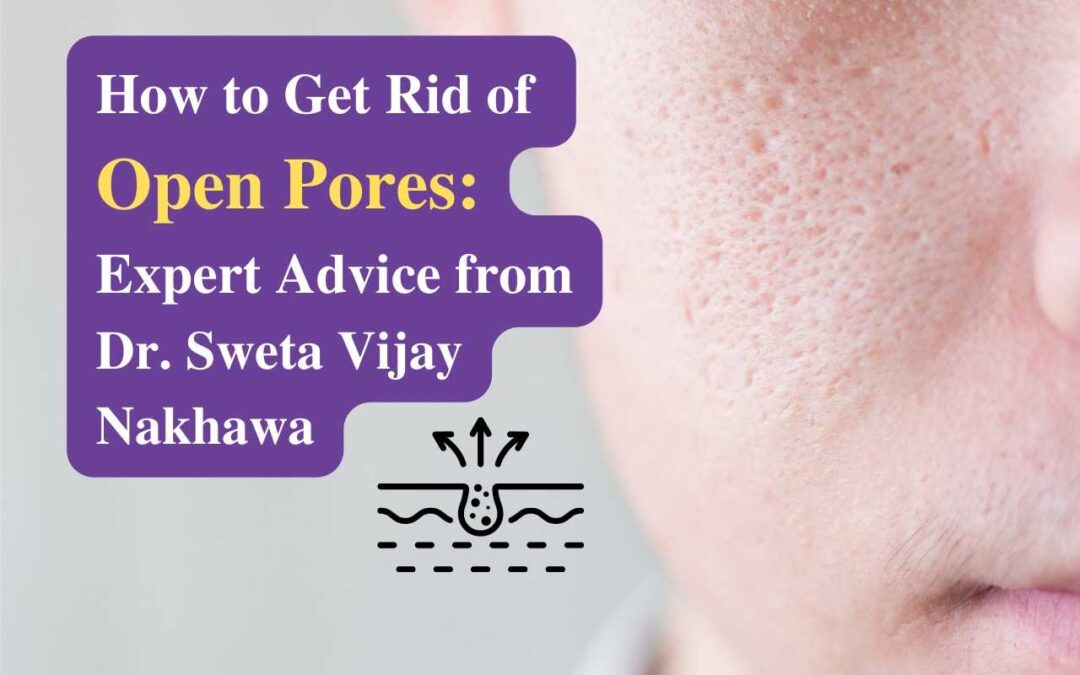 How to Get Rid of Open Pores?