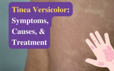 Tinea Versicolor Causes, Symptoms, and Treatment