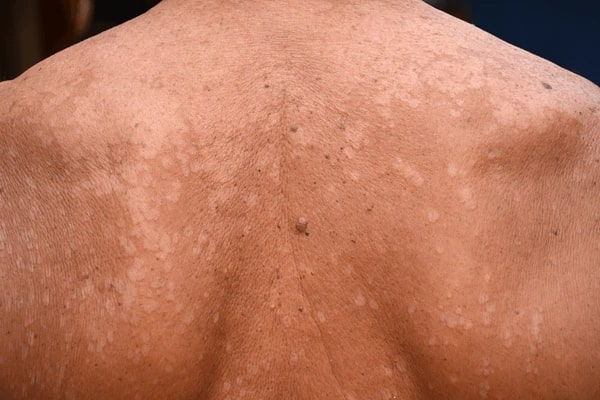 Tinea Versicolor treatment