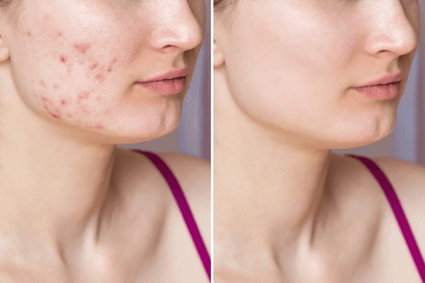 How Can I Prevent Acne