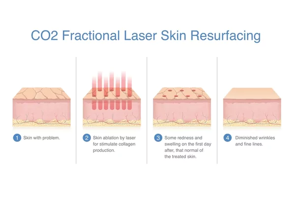 CO2 Fractional Laser CO2 Fractional Laser