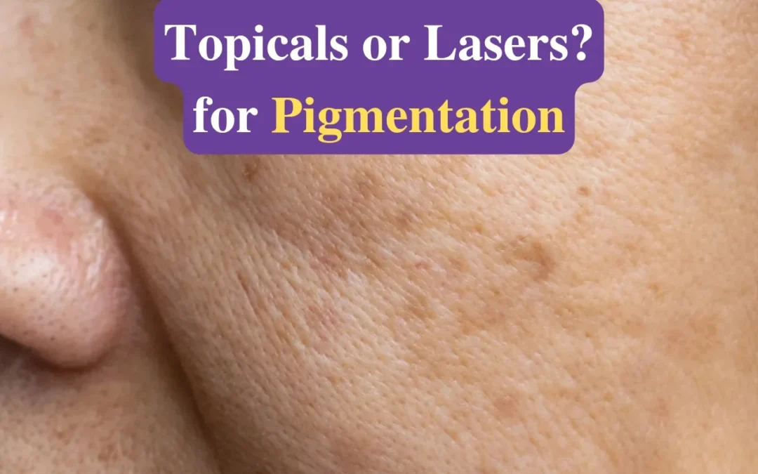 Topicals or Laser for Pigmentation?