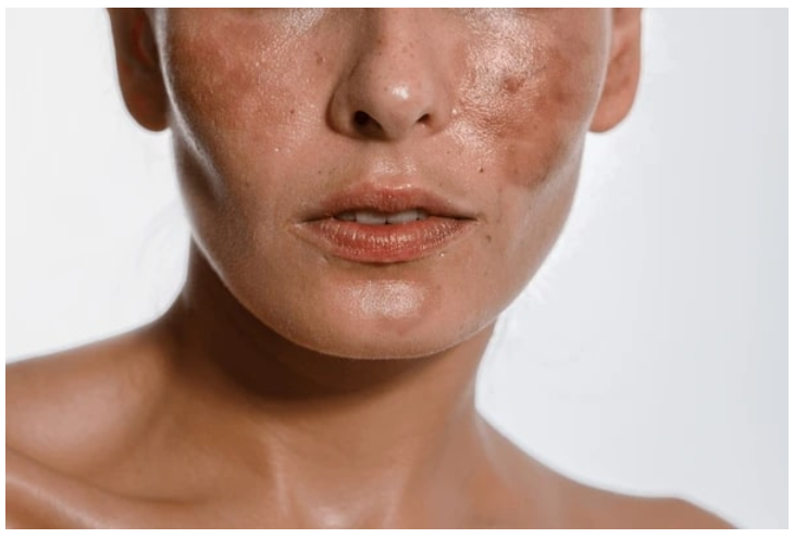 Skin Pigmentation