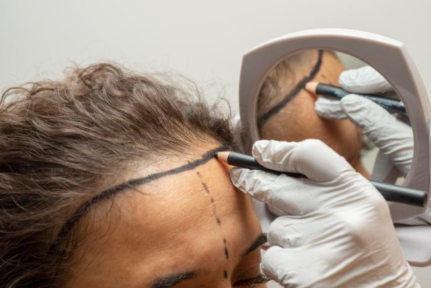 Hair Transplant for Women