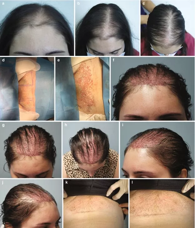 fue-hair-transplant-for-women