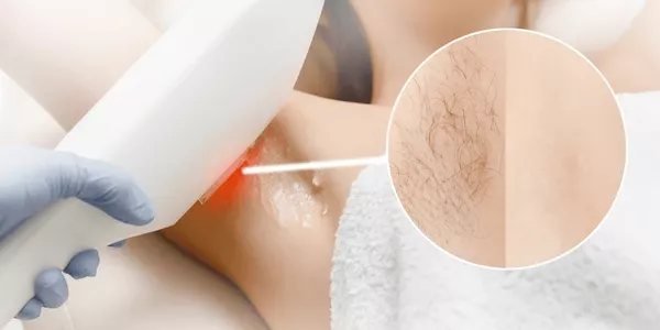 women-underarm-laser-hair-removal